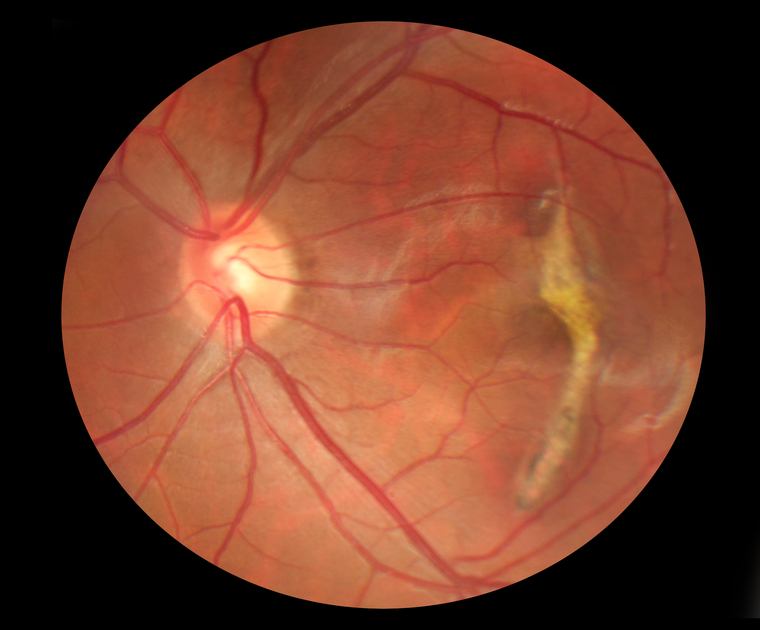 optomap retinal exam